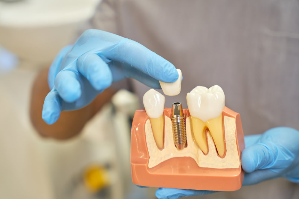 implant kimler için uygundur