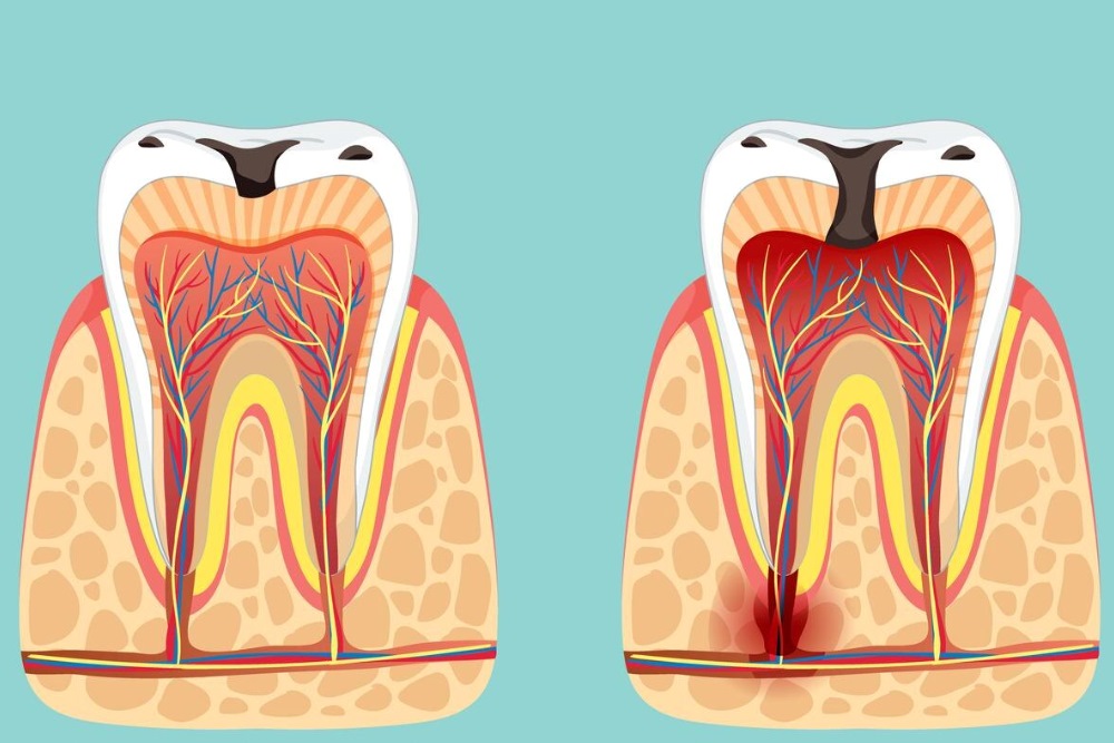çürük sızıntısı nedir
