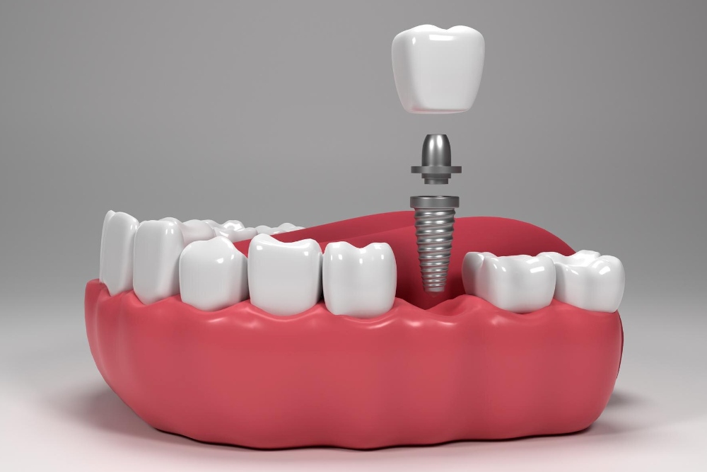 implant tedavisi sonrası dikkat edilmesi gerekenler