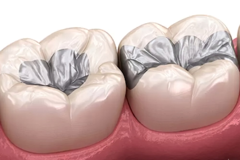 amalgam dolgu kompozit dolgudan farkı nedir