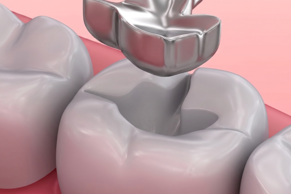 amalgam dolgu nedir