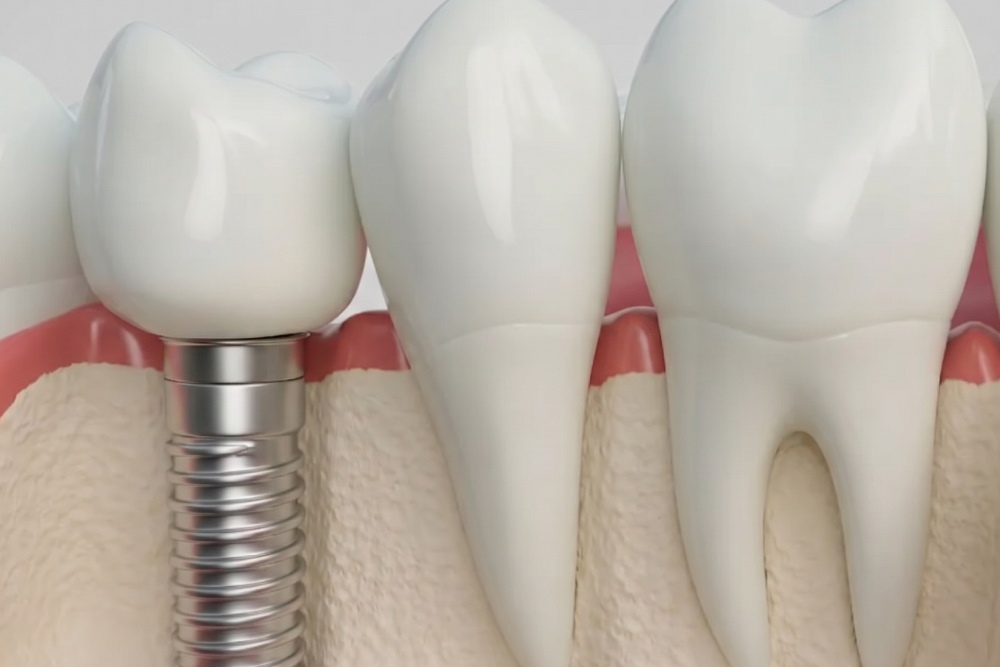 başarısız implant nasıl anlaşılır
