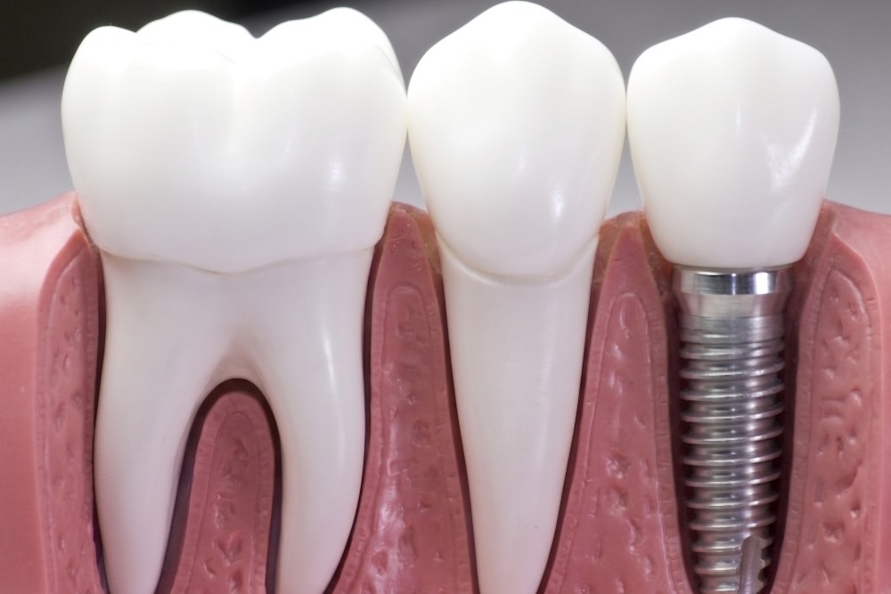 implant başarısız olur mu